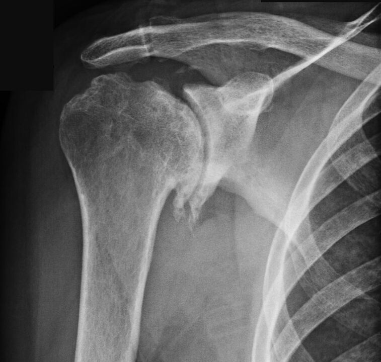 An X-ray showed osteoarthritis of the shoulder