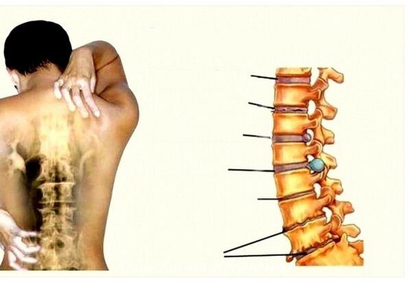 Stages of cervical osteochondrose