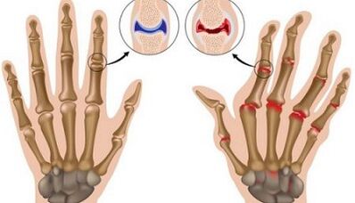 Main differences of arthritis and arthrosis