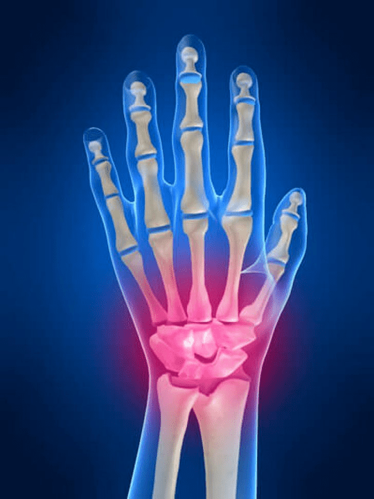 Arthritis joint wrist