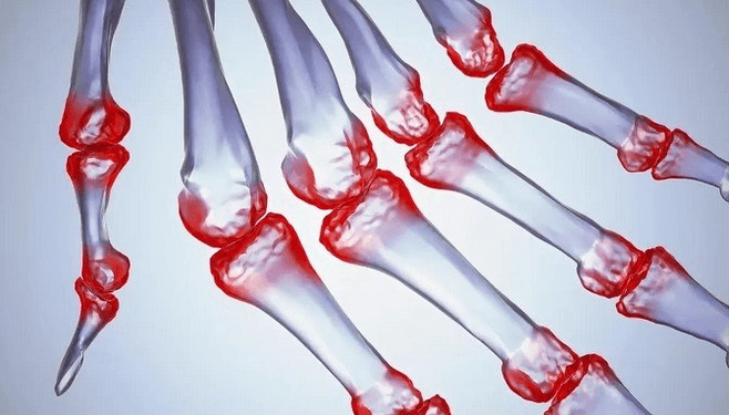 Finger joint pain