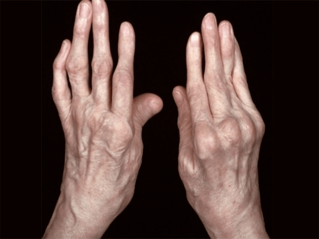 arthritis as the cause of pain in the joints of your fingers