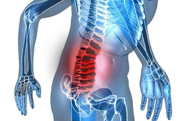 Deformity of the spine in the fourth stage of lumbar osteochondrosis