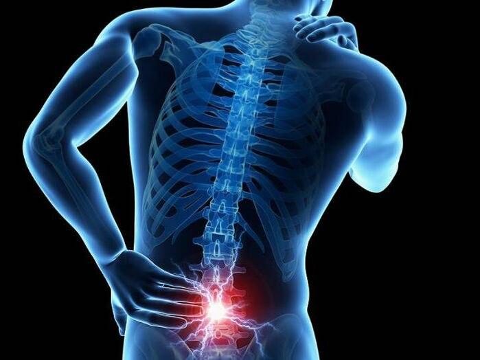 In radiculitis, pinched nerve roots cause sharp pain in the lower back
