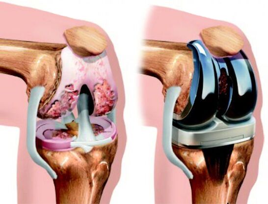 Endoprosthesis replacement is a surgical method of treatment in which the affected joint is replaced with a prosthesis.