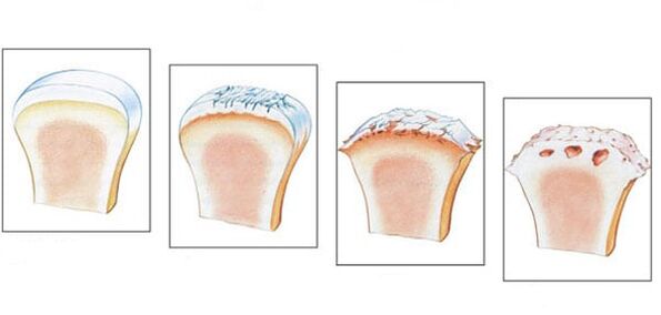 A healthy joint and 3 stages of arthrosis development