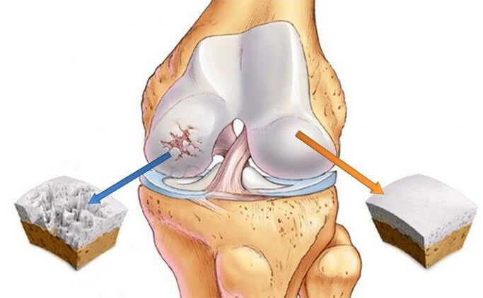 Healthy and arthritic joints