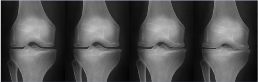 Stages of arthrosis according to the Kellgren-Lawrence classification